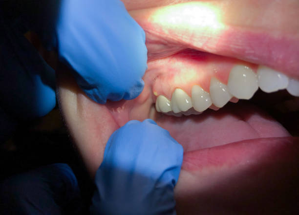 Best Emergency Dentist for Lost Fillings or Crowns in Conesus Lake, NY