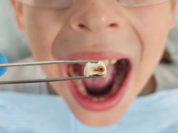 Best Emergency Dentist for Knocked-Out Tooth in Conesus Lake, NY